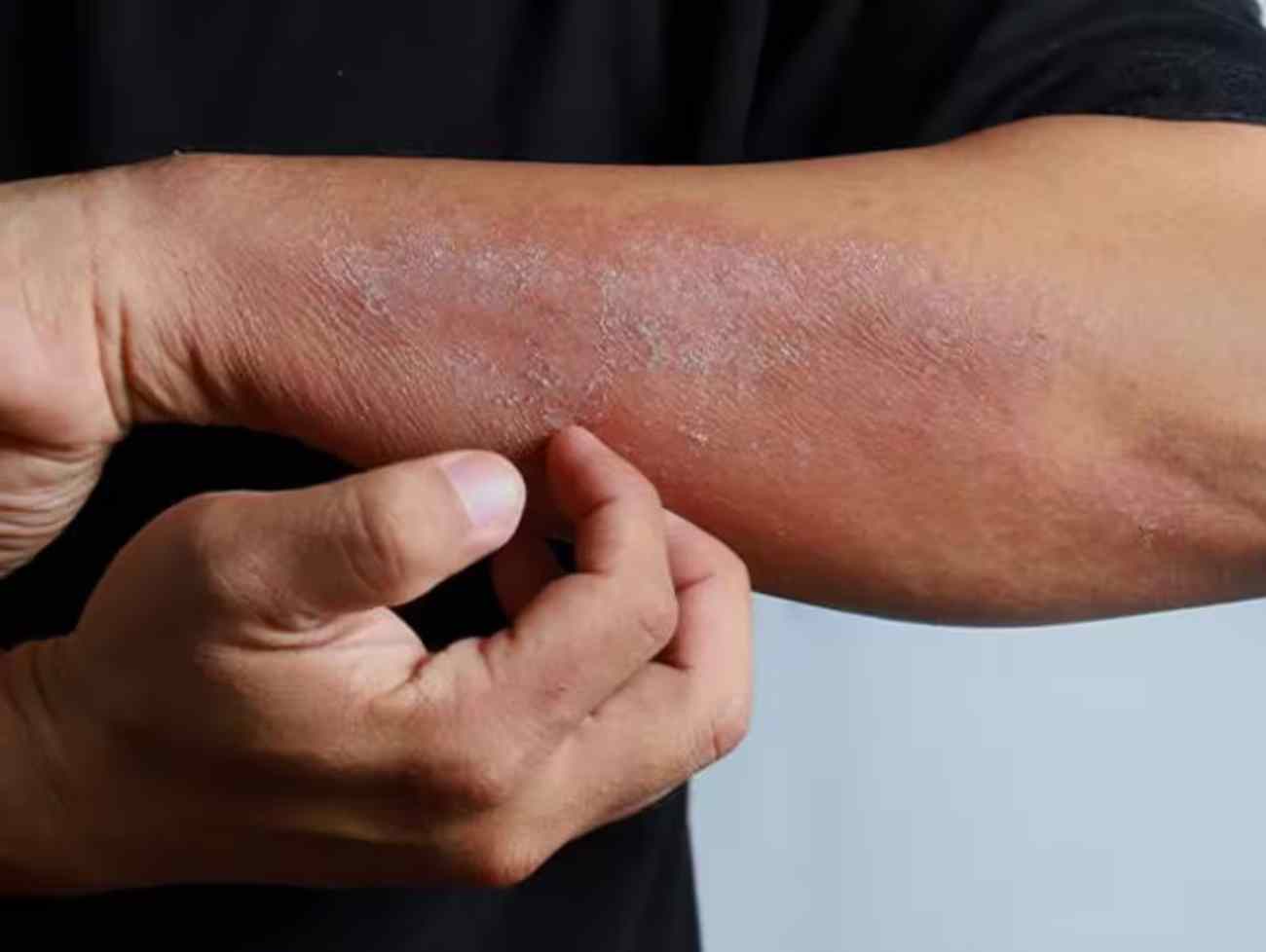 Skin Infection: ચોમાસામાં થતા ત્વચાના રોગથી છુટકારો મેળવવા અપનાવો આ ઘરેલુ નુસખા