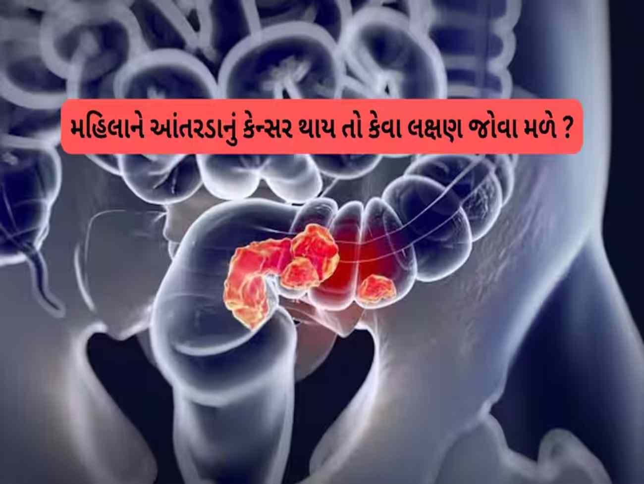 Colon Cancer: આંતરડાના કેન્સરમાં મહિલાઓમાં જોવા મળતાં લક્ષણો, ખોરાકમાં ઓછું ફાઈબર કોલન કેન્સર થવાનું રિસ્ક વધારે